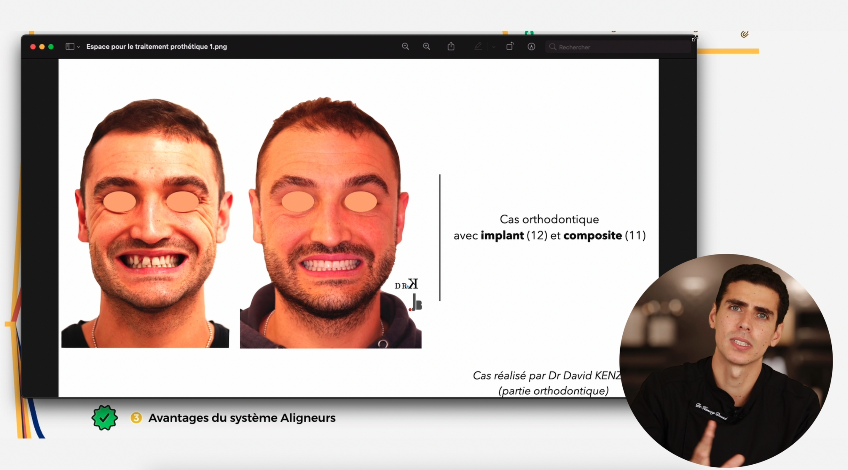 Indication des aligneurs en omnipratique