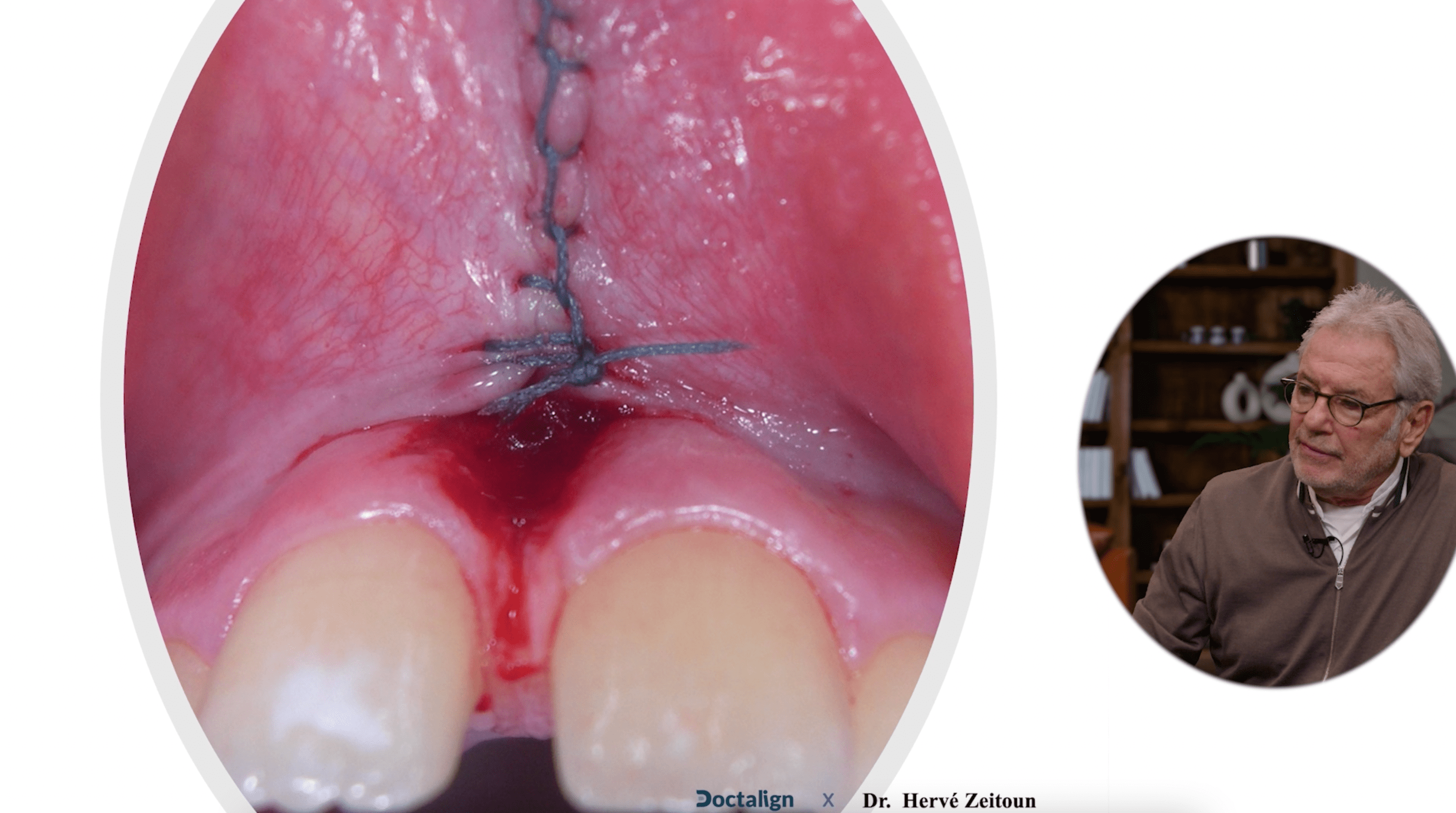 Techniques chirurgicales frénectomie
